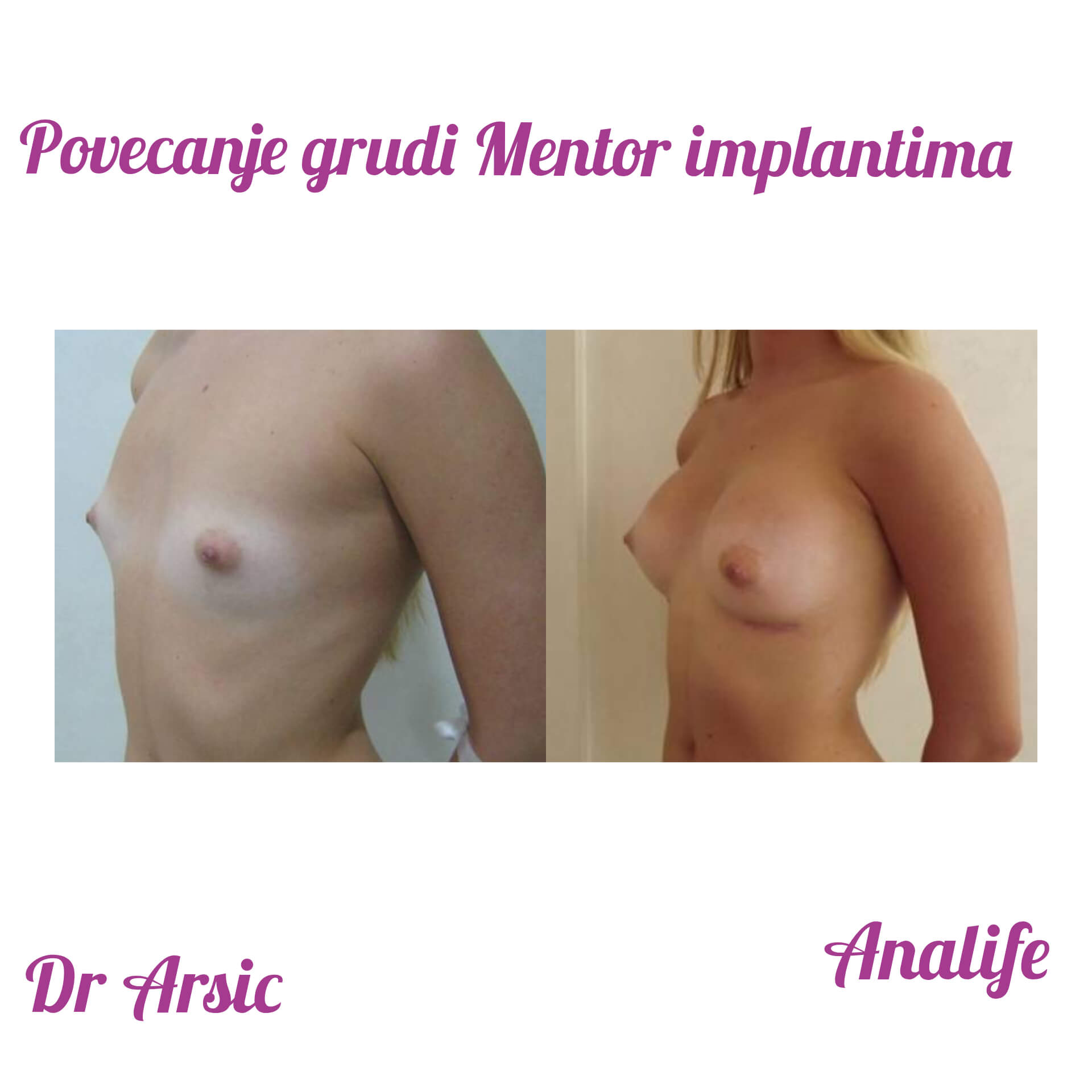 Povećanje grudi (augmentacija) – prirodan volumen i sklad proporcija - slika 85