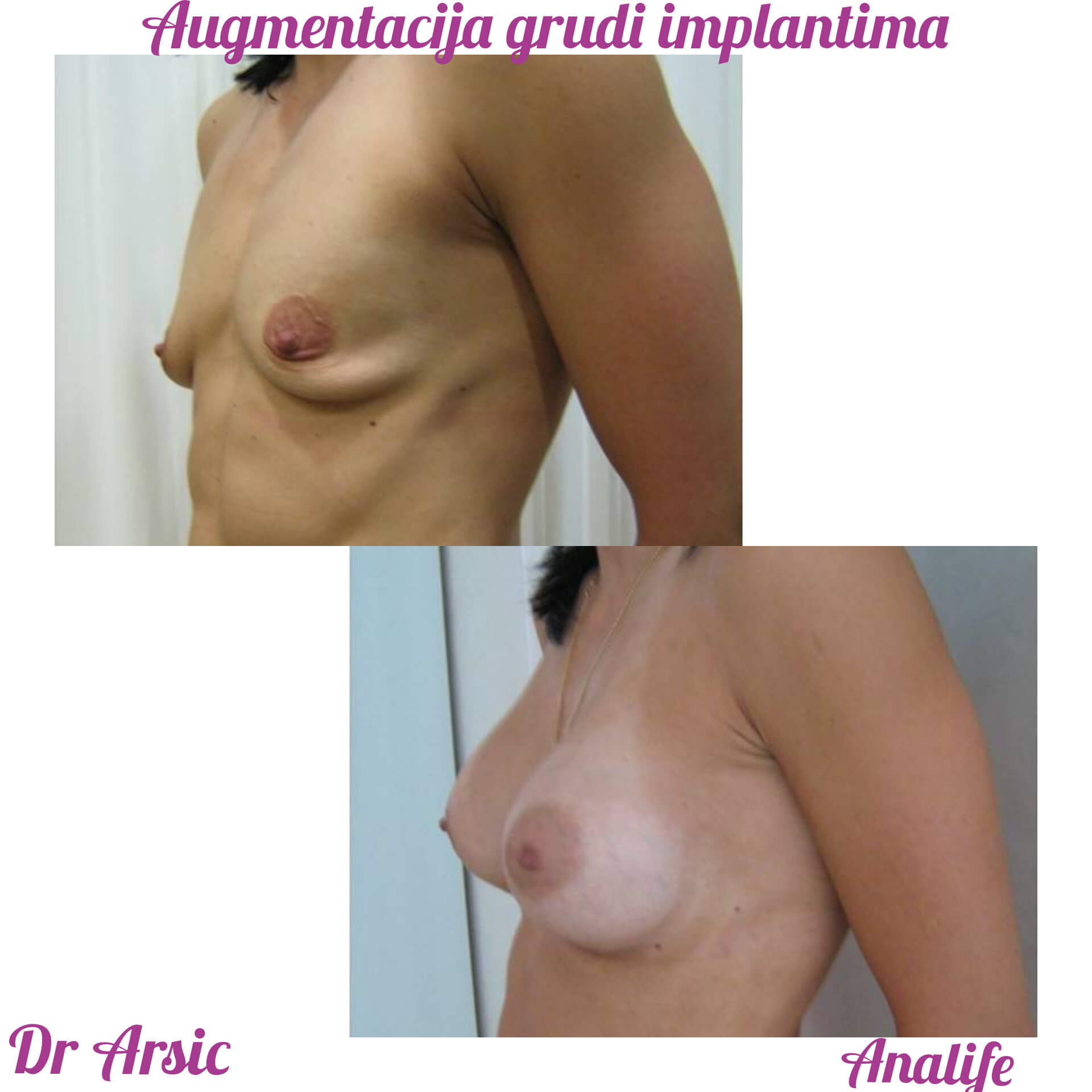 Povećanje grudi (augmentacija) – prirodan volumen i sklad proporcija - slika 86