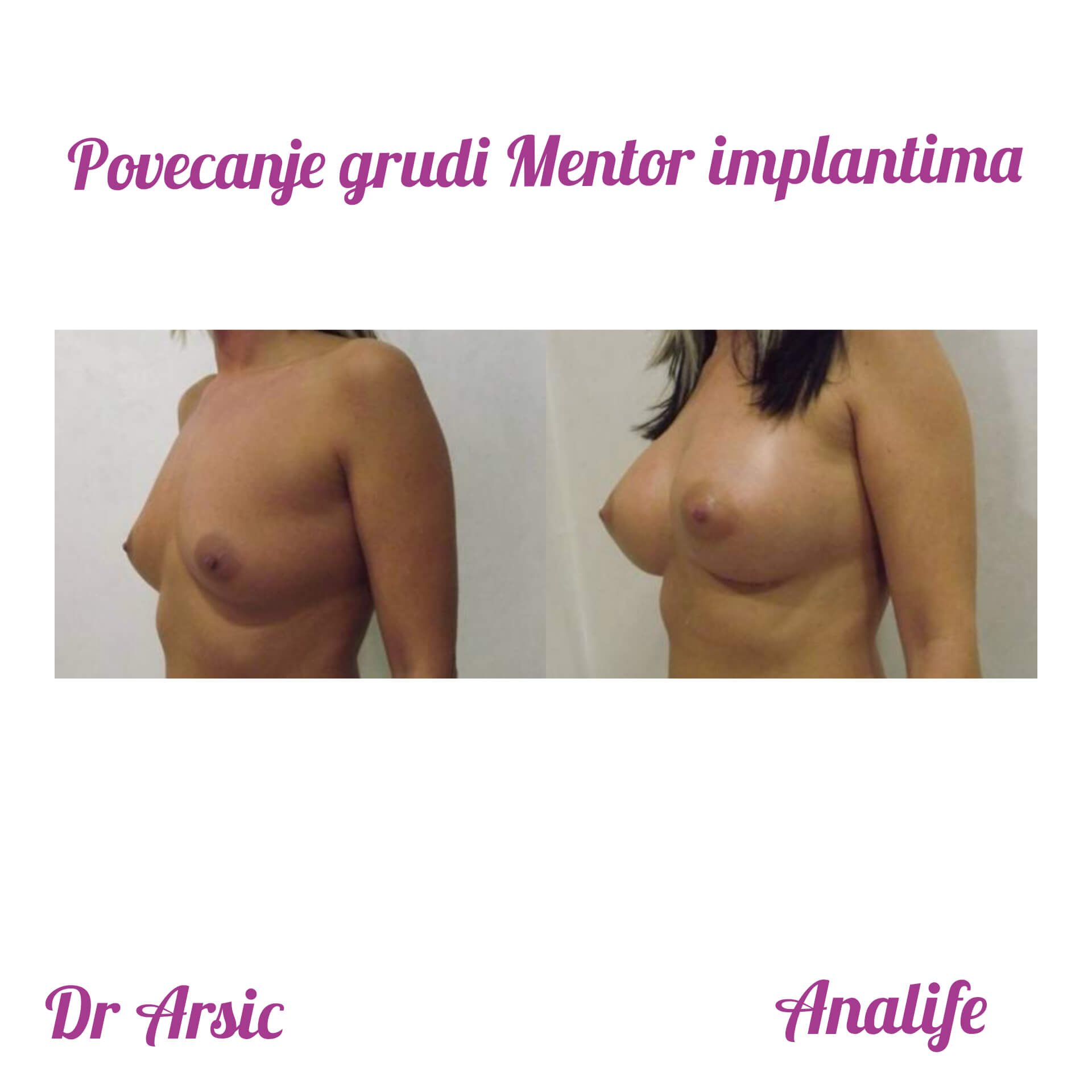 Povećanje grudi (augmentacija) – prirodan volumen i sklad proporcija - slika 87