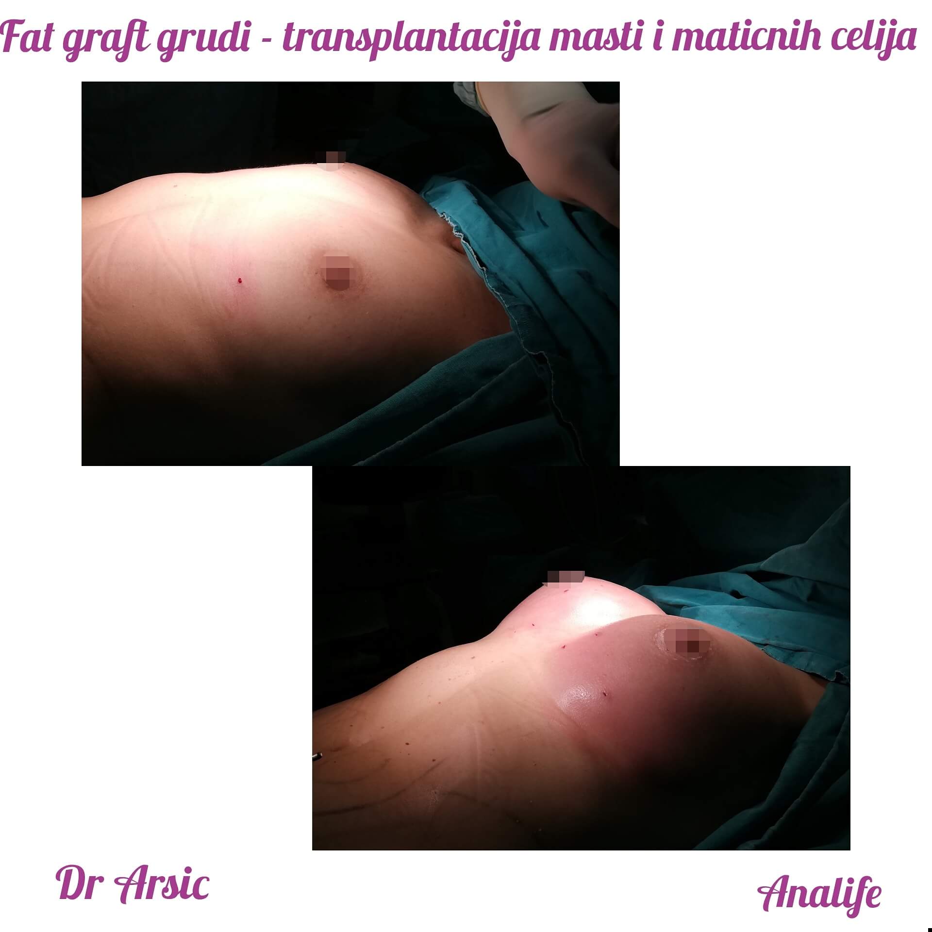 Povećanje grudi (augmentacija) – prirodan volumen i sklad proporcija - slika 91