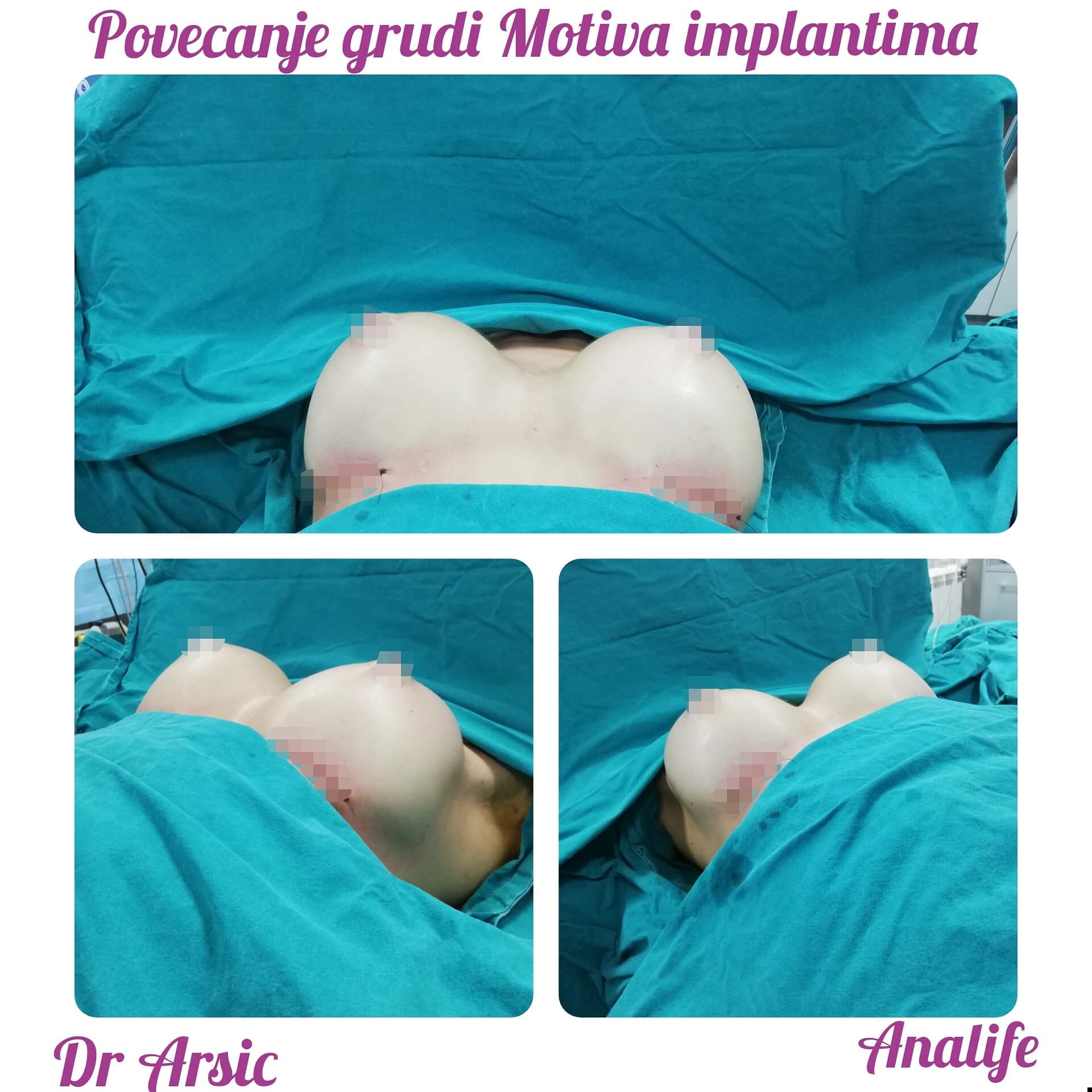 Povećanje grudi (augmentacija) – prirodan volumen i sklad proporcija - slika 98