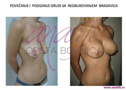 Podizanje grudi (mastopeksija) – vraćanje oblika i čvrstine dojki - slika 2