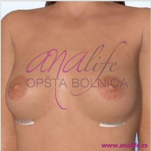 Podizanje grudi (mastopeksija) – vraćanje oblika i čvrstine dojki - slika 8