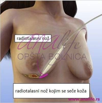 Podizanje grudi (mastopeksija) – vraćanje oblika i čvrstine dojki - slika 19
