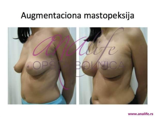 Podizanje grudi (mastopeksija) – vraćanje oblika i čvrstine dojki - slika 23