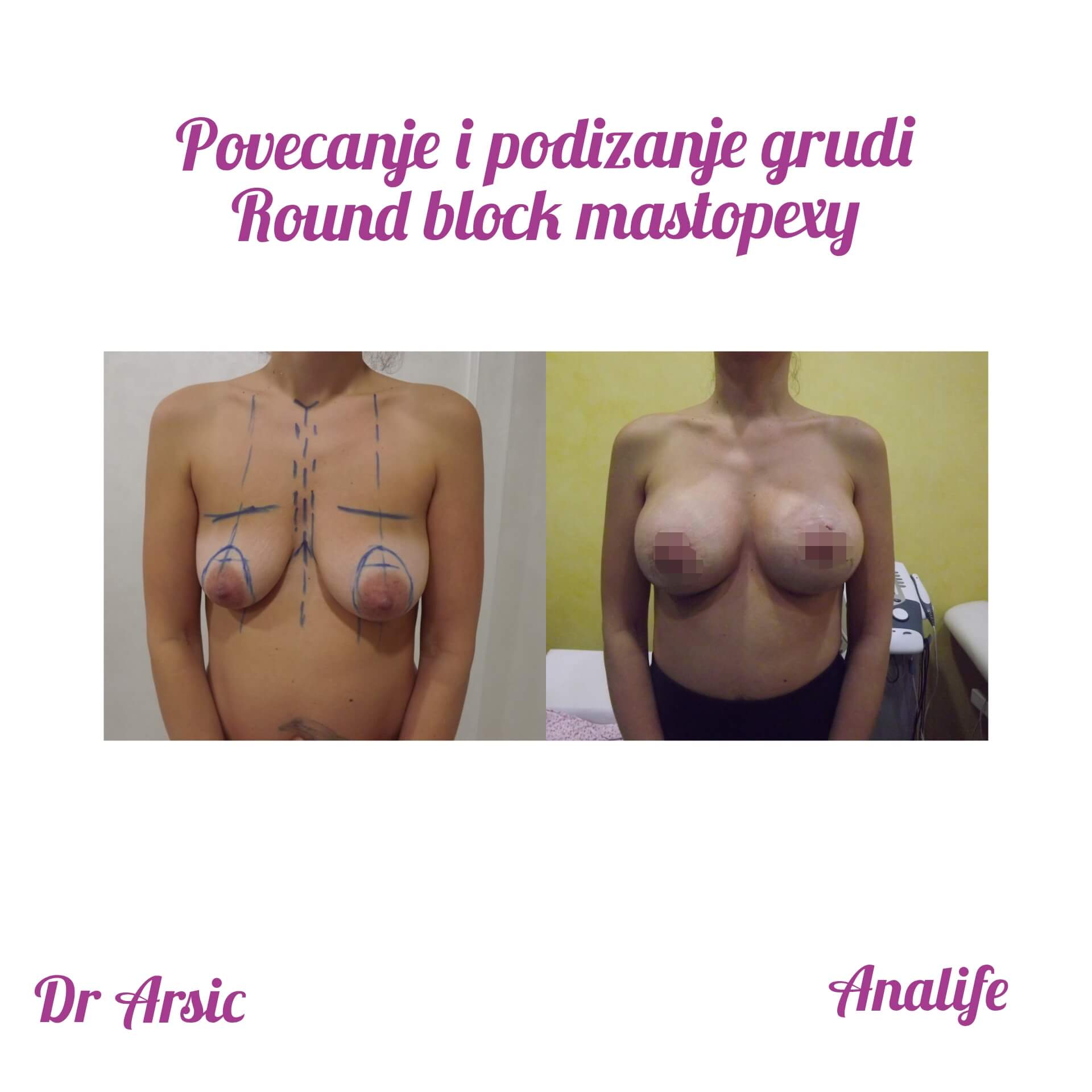 Podizanje grudi (mastopeksija) – vraćanje oblika i čvrstine dojki - slika 25