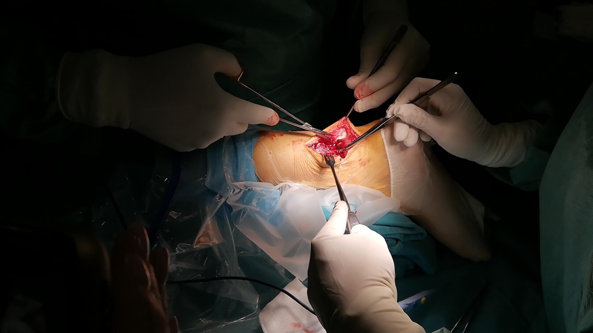Operacija Ahilove tetive – savremeno lečenje rupture i hroničnog bola - slika 8