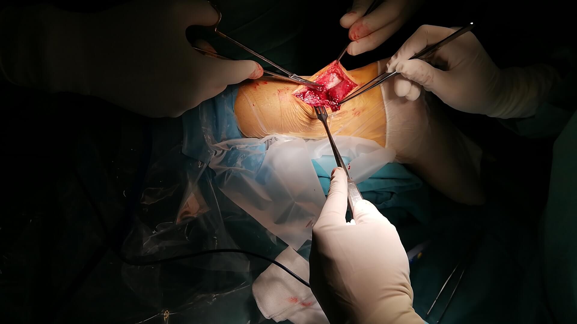 Operacija Ahilove tetive – savremeno lečenje rupture i hroničnog bola - slika 9