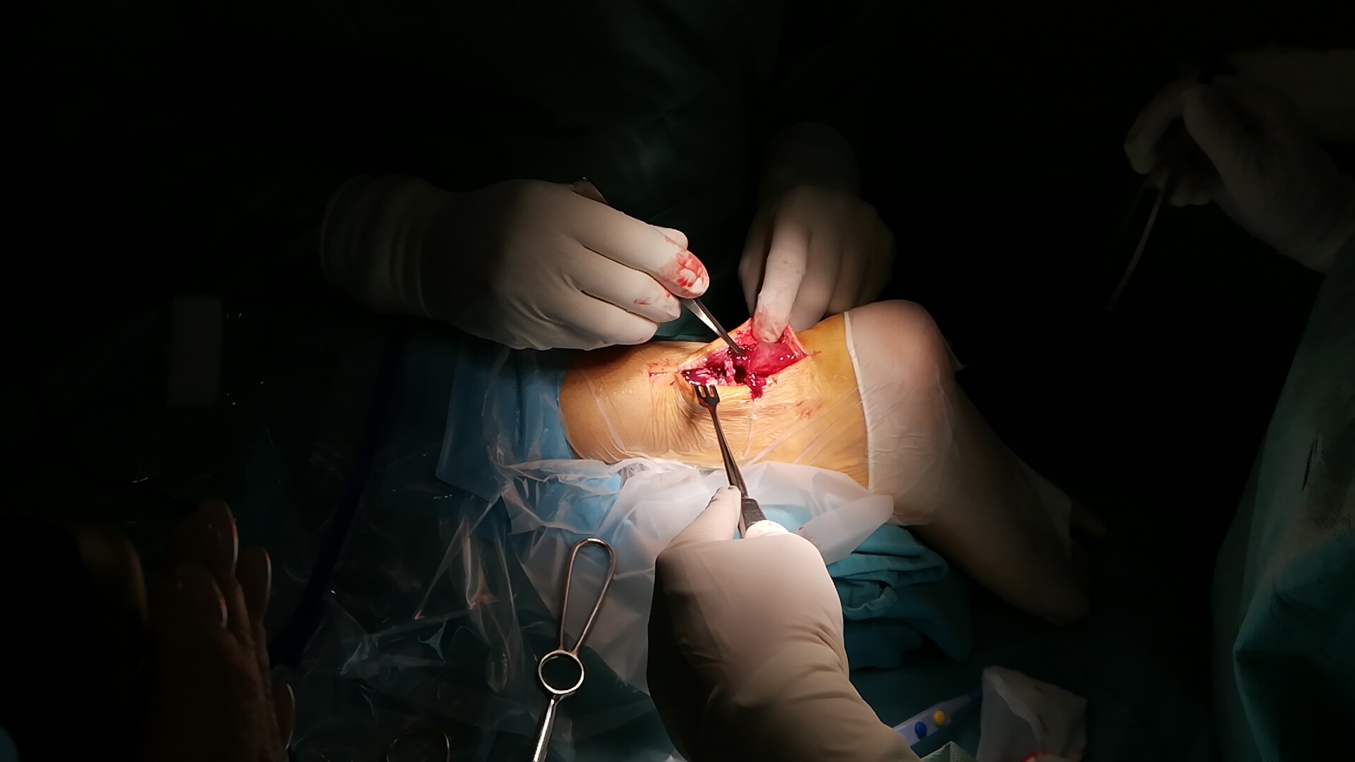 Operacija Ahilove tetive – savremeno lečenje rupture i hroničnog bola - slika 10