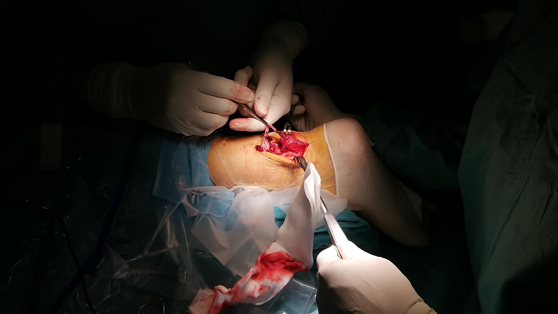 Operacija Ahilove tetive – savremeno lečenje rupture i hroničnog bola - slika 11