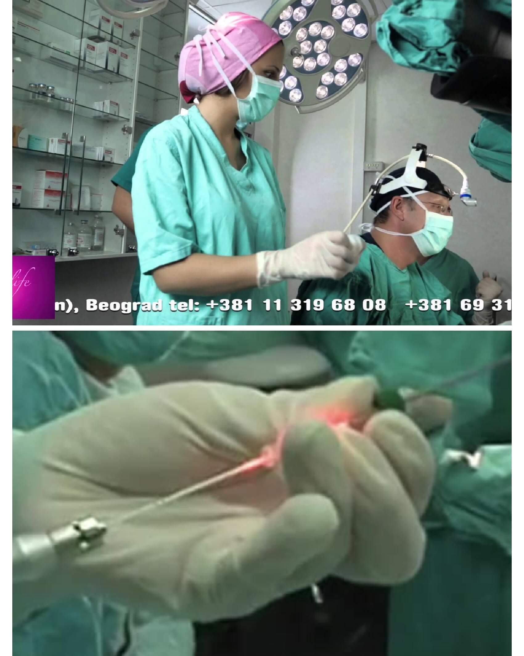 Hemoroidi (šuljevi) – laserska operacija, LigaSure i THD lečenje hemoroida - slika 8