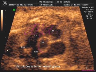 Ekspertski 4D ultrazvuk sa fetalnom ehokardiografijom u 20–24. nedelji trudnoće - slika 5