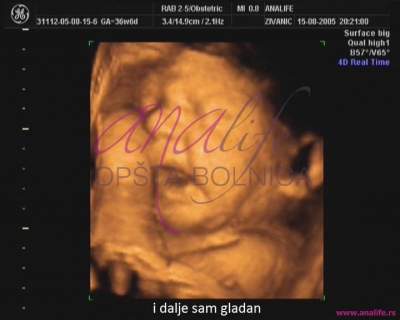 Ekspertski 4d Ultrazvuk Od 25 27 Nedelje Trudnoce Opsta Bolnica Analife