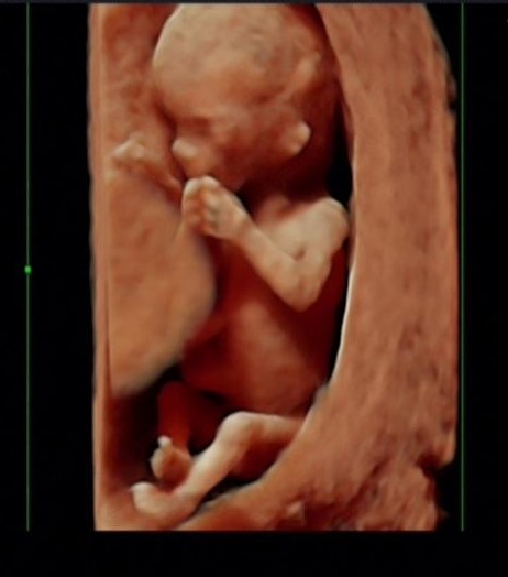 Ekspertski 4d Ultrazvuk Od 11 13 Nedelje Trudnoce Opsta Bolnica Analife