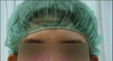 1534502921_plastična hirurgija operacije ušiju galerija 3