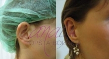 1534502922_plastična hirurgija operacije ušiju galerija 6
