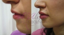 1535792353_plastična hirurgija povećanje i smanjenje usana galerija 5