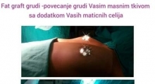 1535968797_plastična hirurgija povećanje grudi sa masnim ćelijama galerija