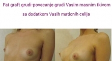 1535968798_plastična hirurgija povećanje grudi sa masnim ćelijama galerija 3