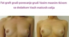 1535968800_plastična hirurgija povećanje grudi sa masnim ćelijama galerija 7