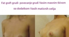 1535968803_plastična hirurgija povećanje grudi sa masnim ćelijama galerija 14