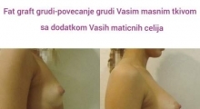 1535968803_plastična hirurgija povećanje grudi sa masnim ćelijama galerija 15