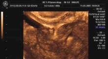 1536142804_ginekologija 3D ultrazvuk male karlice galerija 3
