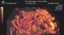 1536142804_ginekologija 3D ultrazvuk male karlice galerija 4