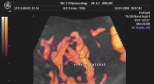 1536142805_ginekologija 3D ultrazvuk male karlice galerija 6