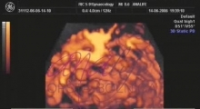 1536142805_ginekologija 3D ultrazvuk male karlice galerija 8