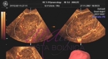1536142806_ginekologija 3D ultrazvuk male karlice galerija 9