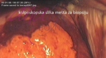 1536143591_ginekologija biopsija grlića materica galerija 6
