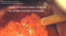 1536143592_ginekologija biopsija grlića materica galerija 10