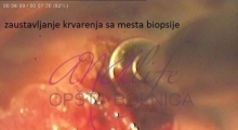 1536143593_ginekologija biopsija grlića materica galerija 11