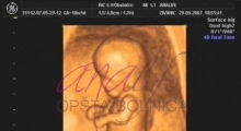 1537263177_trudnoća pregled u 10 nedelji trudnoće galerija 2