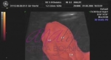 1537264987_trudnoća ekspertski 4D ultrazvuk od 11 13 nedelje trudnoće galerija 2