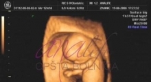 1537264987_trudnoća ekspertski 4D ultrazvuk od 11 13 nedelje trudnoće galerija