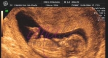 1537264988_trudnoća ekspertski 4D ultrazvuk od 11 13 nedelje trudnoće galerija 3