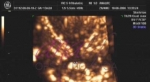 1537264990_trudnoća ekspertski 4D ultrazvuk od 11 13 nedelje trudnoće galerija 7