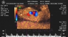 1537264992_trudnoća ekspertski 4D ultrazvuk od 11 13 nedelje trudnoće galerija 10