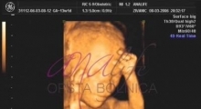 1537264993_trudnoća ekspertski 4D ultrazvuk od 11 13 nedelje trudnoće galerija 12