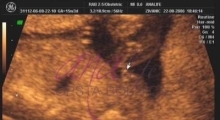 1537266084_trudnoca ekspertski 4D ultrazvuk od 14 19 nedelje trudnoce galerija 5