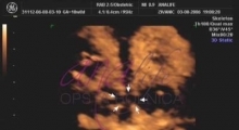 1537266085_trudnoca ekspertski 4D ultrazvuk od 14 19 nedelje trudnoce galerija 8