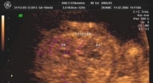 1537266086_trudnoca ekspertski 4D ultrazvuk od 14 19 nedelje trudnoce galerija 10
