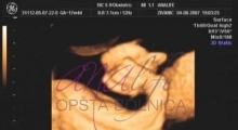 1537347721_trudnoća anomalije u trudnoći galerija 3