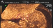 1537347722_trudnoća anomalije u trudnoći galerija 5