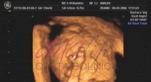 1537347723_trudnoća anomalije u trudnoći galerija 6