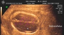 1537347725_trudnoća anomalije u trudnoći galerija 10