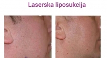 1543055326_02.plasticna hirurgija laserska liposukcija podvaljka i obraza