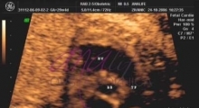 1543228341_11.trudnoća ekspertski 4D ultrazvuk od 20 24 nedelje trudnoće galerija